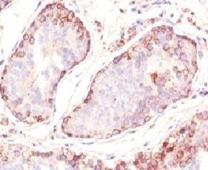 IHC: Formalin-fixed, paraffin-embedded human testicular carcinoma stained with MAGE-1 antibody (clone MZ2E/838).
