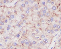 IHC staining of FFPE human liver cancer with LAMP-2A antibody. HIER: boil tissue sections in pH6, 10mM citrate buffer, for 10-20 min and allow to cool before testing.
