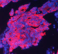 Immunofluorescent staining of human intestinal cancer with Cytokeratin 19 antibody at 1ug/ml. HIER: boil tissue sections in pH6, 10mM citrate buffer, for 10-20 min followed by cooling at RT for 20 min.