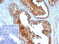 IHC staining of FFPE human prostate cancer tissue with Interleukin 10 antibody (clone IL10/8711). Inset: PBS used in place of primary Ab (secondary Ab negative control). HIER: boil tissue sections in pH 9 10mM Tris with 1mM EDTA for 20 min and allow to cool before testing.