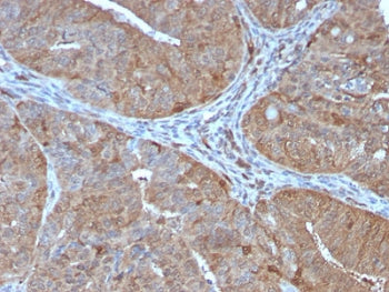 AKR1B1 Antibody Prostate IHC. Immunohistochemistry analysis of FFPE human prostate tissue stained with AKR1B1 Antibody clone CPTC-AKR1B1-2. Strong cytoplasmic HRP-DAB brown staining is observed throughout glandular epithelial cells, consistent with the expected intracellular localization of Aldose reductase / AKR1B1, an oxidative stress-associated metabolic enzyme involved in reactive aldehyde detoxification, glucose-responsive signaling, and cellular redox regulatory pathways.