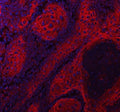 Immunofluorescent staining of FFPE human skin cancer tissue with LYPD3 antibody (red) and DAPI nuclear stain (blue). HIER: steam section in pH8 EDTA buffer for 20 min.