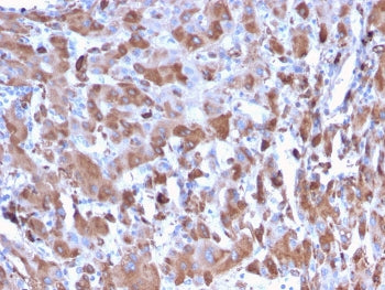 IHC staining of FFPE human liver with C1QA antibody. HIER: boil tissue sections in pH 9 10mM Tris with 1mM EDTA for 10-20 min and allow to cool before testing.
