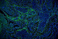 Immunofluorescent staining of FFPE human breast cancer tissue with Vinculin antibody (green) and DAPI nuclear stain (blue). HIER: steam section in pH6 citrate buffer for 20 min.