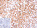 IHC staining of FFPE human hepatocellular carcinoma tissue with CYP2C9 antibody (clone CYP2C9/13121). Inset: PBS used in place of primary Ab (secondary Ab negative control). HIER: boil tissue sections in pH 9 10mM Tris with 1mM EDTA for 20 min and allow to cool before testing.