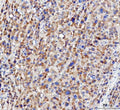 IHC staining of FFPE human liver cancer tissue with NUDT6 antibody. HIER: boil tissue sections in pH8 EDTA for 20 min and allow to cool before testing.
