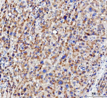 IHC staining of FFPE human liver cancer tissue with NUDT6 antibody. HIER: boil tissue sections in pH8 EDTA for 20 min and allow to cool before testing.