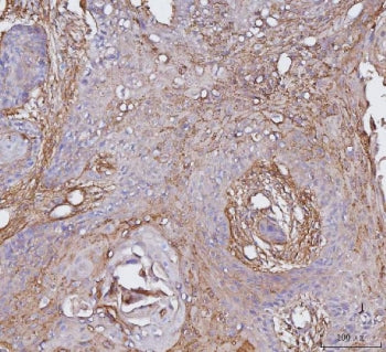 IHC staining of FFPE human esophageal squamous carcinoma tissue with CD51 antibody. HIER: boil tissue sections in pH8 EDTA for 20 min and allow to cool before testing.