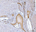 IHC staining of FFPE human endometrial cancer tissue with Clusterin antibody. HIER: boil tissue sections in pH8 EDTA for 20 min and allow to cool before testing.