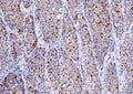 IHC staining of FFPE human liver cancer tissue with CDK2 antibody. HIER: boil tissue sections in pH8 EDTA for 20 min and allow to cool before testing.
