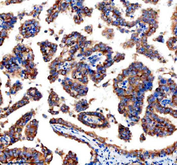 Immunohistochemical staining of GEF-H1/ARHGEF2 using anti-ARHGEF2 antibody. GEF-H1/ARHGEF2 was detected in a paraffin-embedded section of human ovarian cancer tissue. Heat mediated antigen retrieval was performed in EDTA buffer (pH 8.0, epitope retrieval solution). The tissue section was blocked with 10% goat serum. The tissue section was then incubated with 2 ug/ml rabbit anti-ARHGEF2 antibody overnight at 4oC.