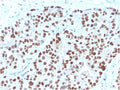 IHC staining of FFPE human prostate carcinoma with NKX3.1 antibody. HIER: boil tissue sections in pH 9 10mM Tris with 1mM EDTA for 20 min and allow to cool before testing.