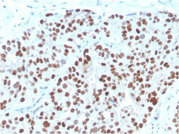 IHC staining of FFPE human prostate carcinoma with NKX3.1 antibody. HIER: boil tissue sections in pH 9 10mM Tris with 1mM EDTA for 20 min and allow to cool before testing.
