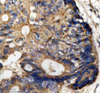 Immunohistochemical staining of MST4/STK26 using anti-STK26 antibody. MST4/STK26 was detected in a paraffin-embedded section of human colon cancer tissue. Heat mediated antigen retrieval was performed in EDTA buffer (pH 8.0, epitope retrieval solution). The tissue section was blocked with 10% goat serum. The tissue section was then incubated with 1: 50 rabbit anti-STK26 antibody overnight at 4oC. Peroxidase Conjugated Goat Anti-rabbit IgG was used as secondary antibody and incubated for 30 min at 37oC.