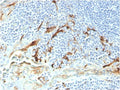 IHC staining of FFPE human endometrial carcinoma with biotinylated Mesothelin antibody (clone MSLN/2131). HIER: boil tissue sections in pH 9 10mM Tris with 1mM EDTA for 20 min and allow to cool before testing.