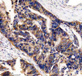 IHC analysis of UBE2A/UBE2B using anti-UBE2A/UBE2B antibody. UBE2A/UBE2B was detected in a paraffin-embedded section of human colon cancer tissue. Heat mediated antigen retrieval was performed in EDTA buffer (pH 8.0, epitope retrieval solution). The tissue section was blocked with 10% goat serum. The tissue section was then incubated with 2 ug/ml rabbit anti-UBE2A/UBE2B antibody overnight at 4oC. Peroxidase Conjugated Goat Anti-rabbit IgG was used as secondary antibody and incubated for 30 min at 37oC.