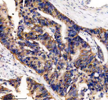 IHC analysis of UBE2A/UBE2B using anti-UBE2A/UBE2B antibody. UBE2A/UBE2B was detected in a paraffin-embedded section of human colon cancer tissue. Heat mediated antigen retrieval was performed in EDTA buffer (pH 8.0, epitope retrieval solution). The tissue section was blocked with 10% goat serum. The tissue section was then incubated with 2 ug/ml rabbit anti-UBE2A/UBE2B antibody overnight at 4oC. Peroxidase Conjugated Goat Anti-rabbit IgG was used as secondary antibody and incubated for 30 min at 37oC.