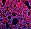 Immunofluorescent staining of TENM2 using anti-TENM2 antibody (red). TENM2 was detected in a paraffin-embedded section of human thyroid cancer tissue. Heat mediated antigen retrieval was performed in EDTA buffer (pH 8.0, epitope retrieval solution). The tissue section was blocked with 10% goat serum. The tissue section was then incubated with 5 ug/ml rabbit anti-TENM2 antibody overnight at 4oC.