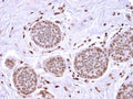 IHC testing of FFPE human breast carcinoma stained with recombinant Mammaglobin antibody (clone MGB/2682R). Required HIER: boiling tissue sections in 10mM citrate buffer, pH6, for 10-20 min followed by cooling at RT for 20 min.