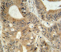 ABCC3 antibody immunohistochemistry analysis in formalin fixed and paraffin embedded human colon carcinoma.