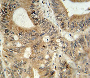ABCC3 antibody immunohistochemistry analysis in formalin fixed and paraffin embedded human colon carcinoma.
