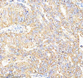 Immunohistochemical staining of Choriogonadotropin alpha/CGA using anti-CGA antibody. Choriogonadotropin alpha/CGA was detected in a paraffin-embedded section of human stomach cancer tissue. Heat mediated antigen retrieval was performed in EDTA buffer (pH 8.0, epitope retrieval solution). The tissue section was blocked with 10% goat serum. The tissue section was then incubated with 2 ug/ml rabbit anti-CGA antibody overnight at 4oC. Peroxidase Conjugated Goat Anti-rabbit IgG was used as secondary antibody an