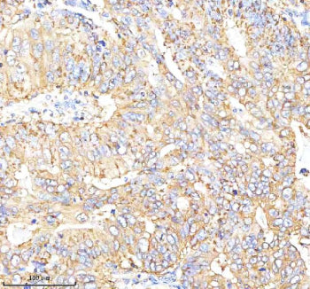 Immunohistochemical staining of Choriogonadotropin alpha/CGA using anti-CGA antibody. Choriogonadotropin alpha/CGA was detected in a paraffin-embedded section of human stomach cancer tissue. Heat mediated antigen retrieval was performed in EDTA buffer (pH 8.0, epitope retrieval solution). The tissue section was blocked with 10% goat serum. The tissue section was then incubated with 2 ug/ml rabbit anti-CGA antibody overnight at 4oC. Peroxidase Conjugated Goat Anti-rabbit IgG was used as secondary antibody an