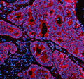 Immunofluorescent staining of PEX1 using anti-PEX1 antibody (red). PEX1 was detected in a paraffin-embedded section of human colon cancer tissue. Heat mediated antigen retrieval was performed in EDTA buffer (pH 8.0, epitope retrieval solution). The tissue section was blocked with 10% goat serum. The tissue section was then incubated with 5 ug/ml rabbit anti-PEX1 antibody overnight at 4oC. Cy3 Conjugated Goat Anti-Rabbit IgG was used as secondary antibody at 1:500 dilution and incubated for 30 min at 37oC.