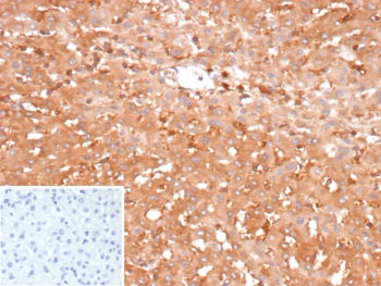 IHC staining of FFPE human hepatocellular carcinoma tissue with Glucose-6-phosphate isomerase antibody (clone GPI/2439). Inset: PBS used in place of primary Ab (secondary Ab negative control). HIER: boil tissue sections in pH 9 10mM Tris with 1mM EDTA for 20 min and allow to cool before testing.