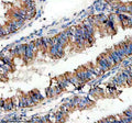Immunohistochemical staining of SIGIRR using anti-SIGIRR antibody. SIGIRR was detected in a paraffin-embedded section of human endometrial cancer tissue. Heat mediated antigen retrieval was performed in EDTA buffer (pH 8.0, epitope retrieval solution). The tissue section was blocked with 10% goat serum. The tissue section was then incubated with 2 ug/ml rabbit anti-SIGIRR antibody overnight at 4oC. Peroxidase Conjugated Goat Anti-rabbit IgG was used as secondary antibody and incubated for 30 min at 37oC.