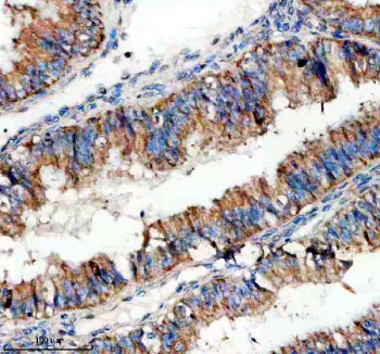 Immunohistochemical staining of SIGIRR using anti-SIGIRR antibody. SIGIRR was detected in a paraffin-embedded section of human endometrial cancer tissue. Heat mediated antigen retrieval was performed in EDTA buffer (pH 8.0, epitope retrieval solution). The tissue section was blocked with 10% goat serum. The tissue section was then incubated with 2 ug/ml rabbit anti-SIGIRR antibody overnight at 4oC. Peroxidase Conjugated Goat Anti-rabbit IgG was used as secondary antibody and incubated for 30 min at 37oC.
