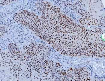 IHC staining of FFPE human laryngeal squamous cell carcinoma tissue with YY1 antibody. HIER: boil tissue sections in pH8 EDTA for 20 min and allow to cool before testing.
