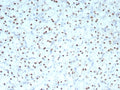 IHC staining of FFPE human renal cell carcinoma tissue with PAX2 antibody (clone PAX2/8671R) at 2ug/ml. HIER: boil tissue sections in pH 9 10mM Tris with 1mM EDTA for 20 min and allow to cool before testing.