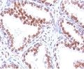 IHC: Formalin-fixed, paraffin-embedded human prostate carcinoma stained with anti-Androgen Receptor antibody (SPM335).