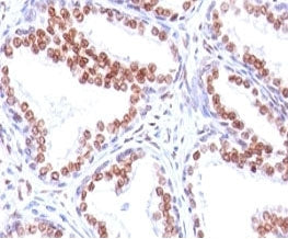 IHC: Formalin-fixed, paraffin-embedded human prostate carcinoma stained with anti-Androgen Receptor antibody (SPM335).