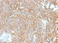 IHC testing of FFPE human gastrointestinal stromal tumor (GIST) with DOG1 antibody (clone DG1/2564R). Required HIER: boil tissue sections in pH 9 10mM Tris with 1mM EDTA for 10-20 min followed by cooling at RT for 20 min.