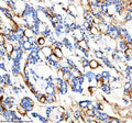 IHC analysis of FYCO1 using anti-FYCO1 antibody. FYCO1 was detected in a paraffin-embedded section of human thyroid cancer tissue. Heat mediated antigen retrieval was performed in EDTA buffer (pH 8.0, epitope retrieval solution). The tissue section was blocked with 10% goat serum. The tissue section was then incubated with 2 ug/ml rabbit anti-FYCO1 antibody overnight at 4oC. Peroxidase Conjugated Goat Anti-rabbit IgG was used as secondary antibody and incubated for 30 min at 37oC.