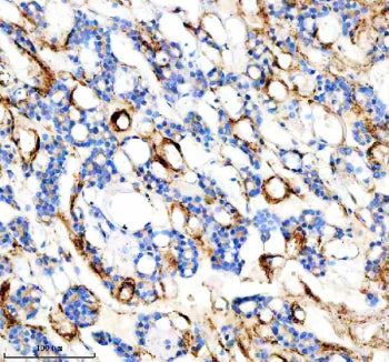 IHC analysis of FYCO1 using anti-FYCO1 antibody. FYCO1 was detected in a paraffin-embedded section of human thyroid cancer tissue. Heat mediated antigen retrieval was performed in EDTA buffer (pH 8.0, epitope retrieval solution). The tissue section was blocked with 10% goat serum. The tissue section was then incubated with 2 ug/ml rabbit anti-FYCO1 antibody overnight at 4oC. Peroxidase Conjugated Goat Anti-rabbit IgG was used as secondary antibody and incubated for 30 min at 37oC.