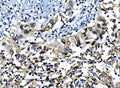 IHC staining of FFPE human lung cancer with IRF-1 antibody. HIER: boil tissue sections in pH8 EDTA for 20 min and allow to cool before testing.