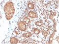 IHC staining of FFPE human colon carcinoma tissue with Interleukin 3 antibody (clone IL3/4004). HIER: boil tissue sections in pH 9 10mM Tris with 1mM EDTA for 20 min and allow to cool before testing.