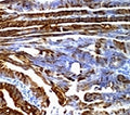 IHC: Formalin-fixed, paraffin-embedded human colon carcinoma stained with MUC2 antibody (SPM296).