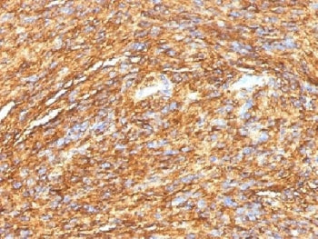 IHC testing of FFPE human gastrointestinal stromal tumor (GIST) with DOG 1 antibody (DG1/1484). Required HIER: boil tissue sections in pH 9 10mM Tris with 1mM EDTA for 10-20 min.