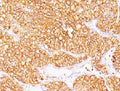 IHC: Formalin-fixed, paraffin-embedded human renal cell carcinoma stained with CA9 antibody (SPM314).