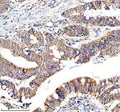 Immunohistochemical staining of NDUF-S2 using anti-NDUF-S2 antibody. NDUF-S2 was detected in a paraffin-embedded section of human colon cancer tissue. Heat mediated antigen retrieval was performed in EDTA buffer (pH 8.0, epitope retrieval solution). The tissue section was blocked with 10% goat serum. The tissue section was then incubated with 1:50 rabbit anti-NDUF-S2 antibody overnight at 4oC. Peroxidase Conjugated Goat Anti-rabbit IgG was used as secondary antibody and incubated for 30 min at 37oC.