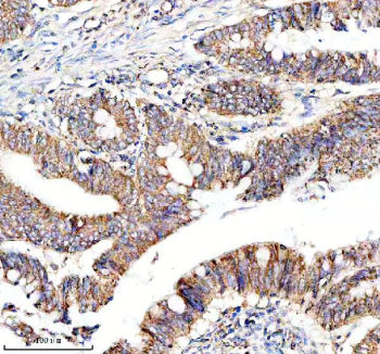 Immunohistochemical staining of NDUF-S2 using anti-NDUF-S2 antibody. NDUF-S2 was detected in a paraffin-embedded section of human colon cancer tissue. Heat mediated antigen retrieval was performed in EDTA buffer (pH 8.0, epitope retrieval solution). The tissue section was blocked with 10% goat serum. The tissue section was then incubated with 1:50 rabbit anti-NDUF-S2 antibody overnight at 4oC. Peroxidase Conjugated Goat Anti-rabbit IgG was used as secondary antibody and incubated for 30 min at 37oC.