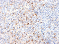 IHC: Formalin-fixed, paraffin-embedded human melanoma stained with recombinant Tyrosinase antibody (clone TYR/2024R). Required HIER: boil tissue sections in 10mM Tris with 1mM EDTA, pH9, or 10mM citrate buffer, pH6, for 10-20 min followed by cooling at RT for 20 min.