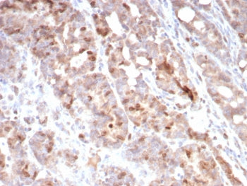 IHC staining of FFPE human colon carcinoma tissue with Survivin antibody (clone BIRC5/7775). HIER: boil tissue sections in pH 9 10mM Tris with 1mM EDTA for 20 min and allow to cool before testing.