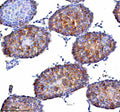 Immunohistochemical staining of STAMBP using anti-STAMBP antibody. STAMBP was detected in a paraffin-embedded section of human rectal adenocarcinoma tissue. Heat mediated antigen retrieval was performed in EDTA buffer (pH 8.0, epitope retrieval solution). The tissue section was blocked with 10% goat serum. The tissue section was then incubated with 2 ug/ml rabbit anti-STAMBP antibody overnight at 4oC. Peroxidase Conjugated Goat Anti-rabbit IgG was used as secondary antibody and incubated for 30 min at 37oC.