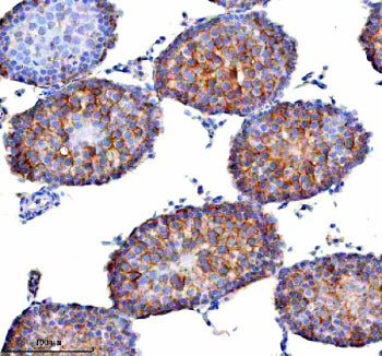 Immunohistochemical staining of STAMBP using anti-STAMBP antibody. STAMBP was detected in a paraffin-embedded section of human rectal adenocarcinoma tissue. Heat mediated antigen retrieval was performed in EDTA buffer (pH 8.0, epitope retrieval solution). The tissue section was blocked with 10% goat serum. The tissue section was then incubated with 2 ug/ml rabbit anti-STAMBP antibody overnight at 4oC. Peroxidase Conjugated Goat Anti-rabbit IgG was used as secondary antibody and incubated for 30 min at 37oC.