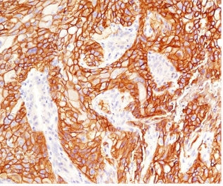IHC testing of FFPE human lung squamous cell carcinoma with EGFR antibody (clone ERB68-1). Required HIER: boiling tissue sections in pH 9 10mM Tris with 1mM EDTA for 10-20 min.